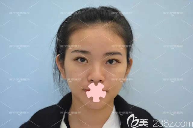 我在南寧夢想整形做隆鼻和豐下巴前的照片 我在南寧夢想整形做隆鼻和豐下巴前的照片