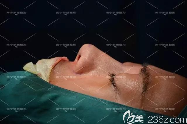 南寧夢想唐超給我做鼻綜合和豐下巴術(shù)后即刻 南寧夢想唐超給我做鼻綜合和豐下巴術(shù)后即刻