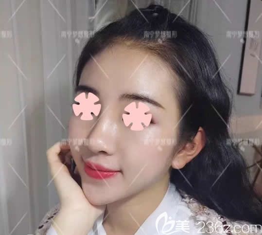 我在南寧夢想整形做鼻綜合和墊下巴術(shù)后第7天 我在南寧夢想整形做鼻綜合和墊下巴術(shù)后第7天