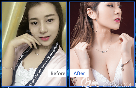 廣州美恩陳宏彬做的隆胸案例 廣州美恩陳宏彬做的隆胸案例