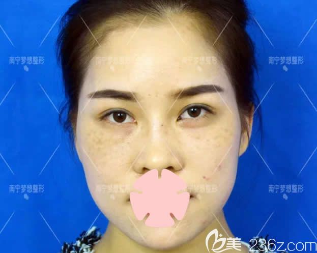 我在南寧夢想整形做超皮秒激光祛斑前的照片 我在南寧夢想整形做超皮秒激光祛斑前的照片