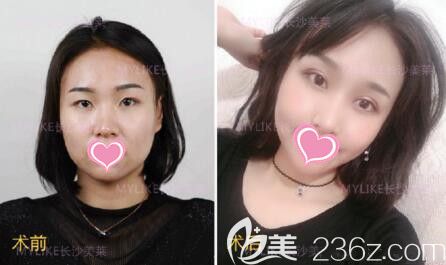 劉歡雙眼皮整形真人前后<span style=