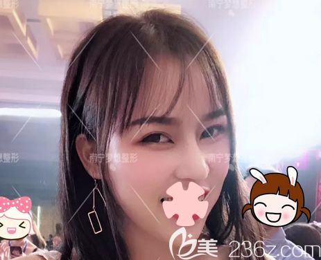 激光祛斑效果如何？上傳我在南寧夢想整形做超皮秒激光祛斑恢復(fù)效果圖片