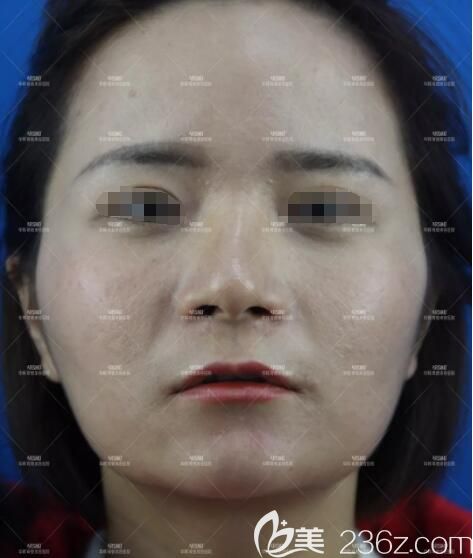 面診南京華韓奇致醫(yī)生術前面部凹陷顯老 面診南京華韓奇致醫(yī)生術前面部凹陷顯老