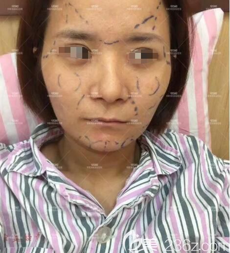 面診醫(yī)生設計納米脂肪膠立體填充手術方案 面診醫(yī)生設計納米脂肪膠立體填充手術方案