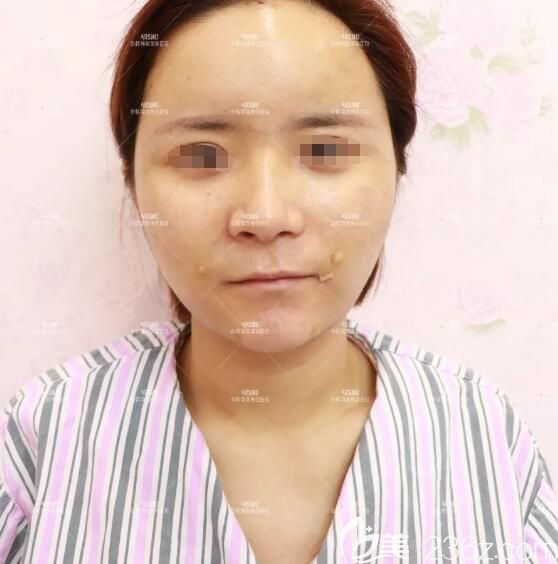 做完納米脂肪膠立體填充術后第二天恢復情況 做完納米脂肪膠立體填充術后第二天恢復情況