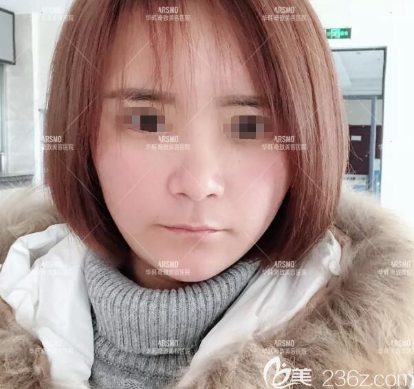 南京華韓奇致分享做納米脂肪膠立體填充術后一周恢復情況 南京華韓奇致分享做納米脂肪膠立體填充術后一周恢復情況