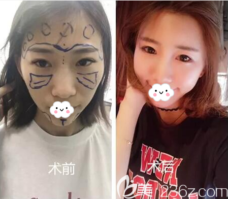 <!--<i data=20240703-sp></i>-->自體脂肪填充全面部術(shù)后對比