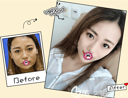 北京惠合嘉美面部射頻美膚案例