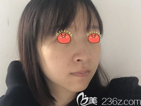 嘉興曙光做駝峰鼻矯正前 嘉興曙光做駝峰鼻矯正前
