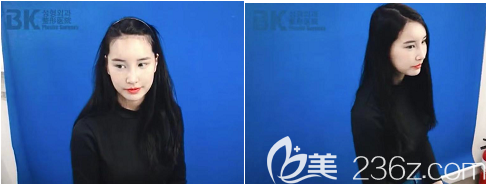 這是我手術(shù)做完之后的側(cè)臉和正臉的樣子