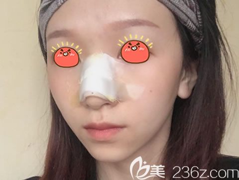 嘉興曙光醫(yī)院做駝峰鼻矯正效果 嘉興曙光醫(yī)院做駝峰鼻矯正效果