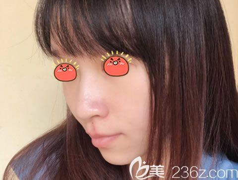 嘉興曙光整形醫(yī)院鼻綜合案例 嘉興曙光整形醫(yī)院鼻綜合案例