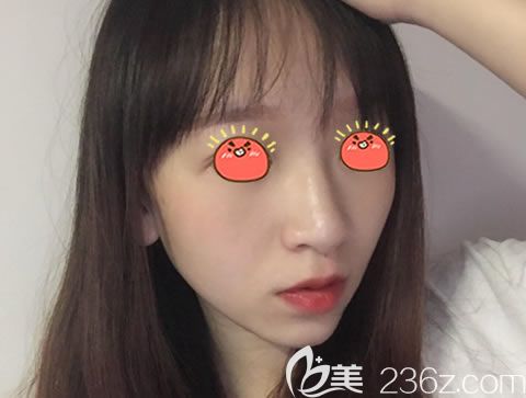 嘉興曙光高俊鼻綜合案例15天效果 嘉興曙光高俊鼻綜合案例15天效果