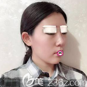 <!--<i data=20240703-sp></i>-->謙醫(yī)生給我做眼綜合術(shù)后當(dāng)天樣子 <!--<i data=20240703-sp></i>-->謙醫(yī)生給我做眼綜合術(shù)后當(dāng)天樣子