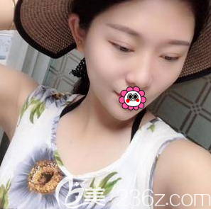 在北京藝星做眼綜合第62天效果 在北京藝星做眼綜合第62天效果