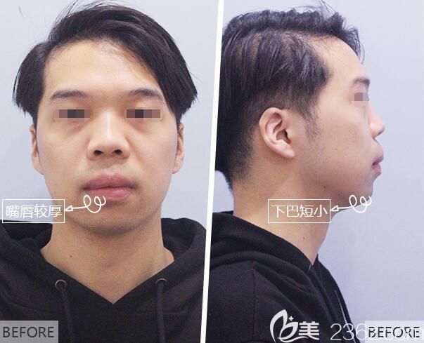 面診南京美貝爾醫(yī)生術(shù)前下巴短小嘴唇較厚 面診南京美貝爾醫(yī)生術(shù)前下巴短小嘴唇較厚