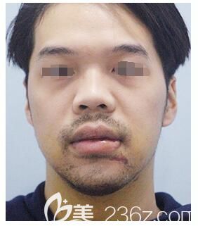 術(shù)后一周拆完線嘴唇和下巴恢復(fù)中 術(shù)后一周拆完線嘴唇和下巴恢復(fù)中