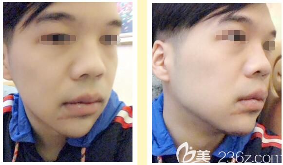 做了厚唇改薄+墊下巴術(shù)后十天恢復(fù)中 做了厚唇改薄+墊下巴術(shù)后十天恢復(fù)中