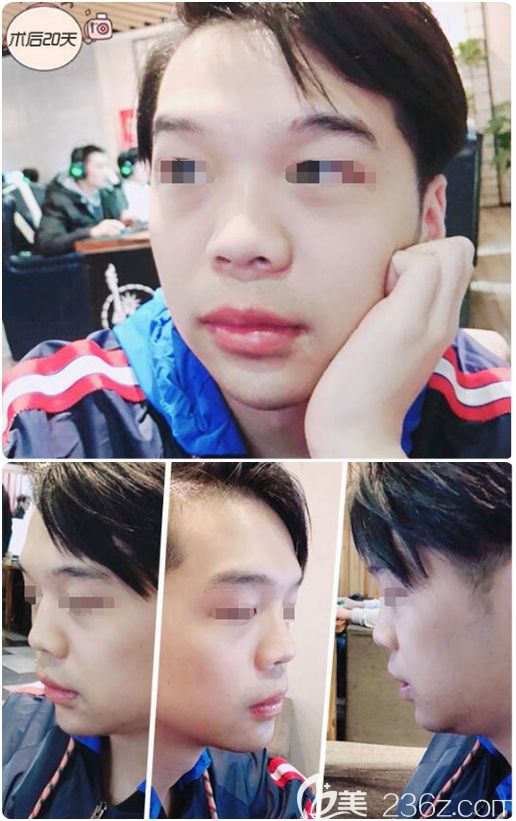 墊下巴+厚唇改薄術(shù)后而十天恢復(fù)中 墊下巴+厚唇改薄術(shù)后而十天恢復(fù)中