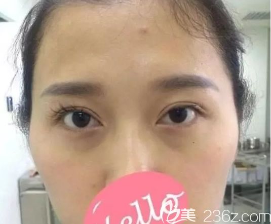蘭州時光整形美容醫(yī)院雙眼皮失敗修復前