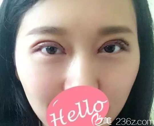 雙眼皮失敗修復第二天效果