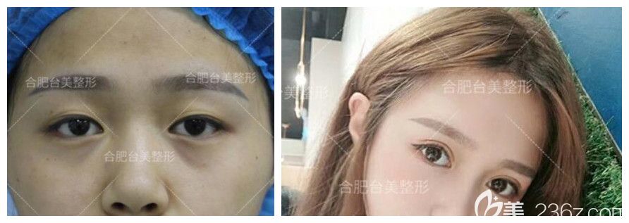 合肥臺美麗格整形好不好？臺美葉凡眼綜合真人案例驗(yàn)證實(shí)力
