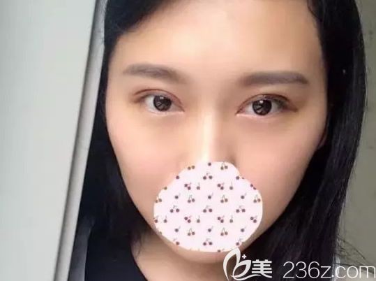 切開雙眼皮第7天拆線后