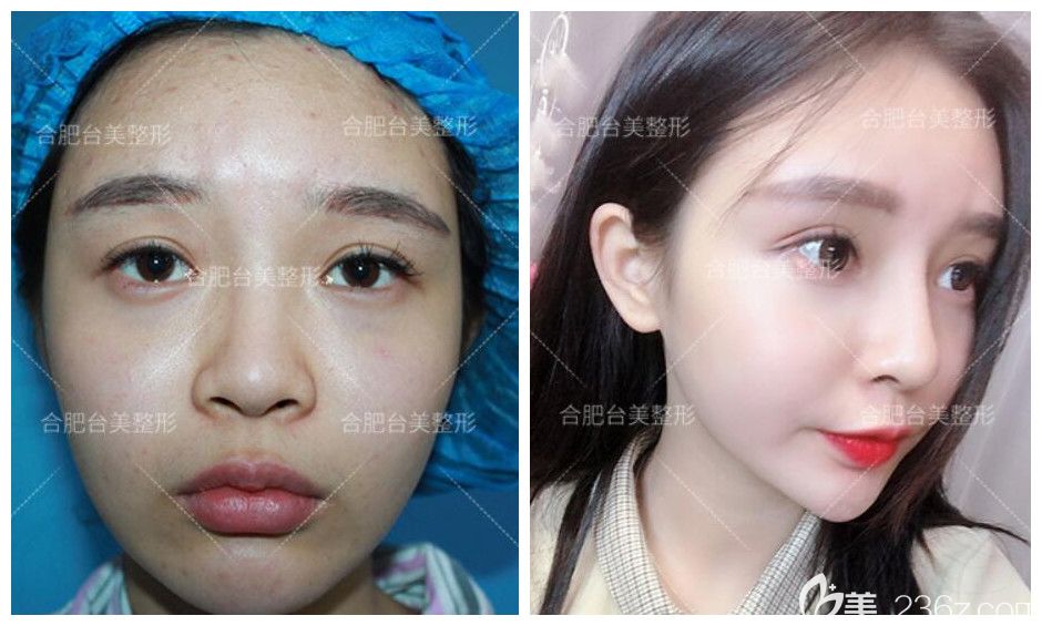 合肥臺美麗格整形正規(guī)嗎？穆威院長生態(tài)隆鼻鼻綜合案例來驗(yàn)證