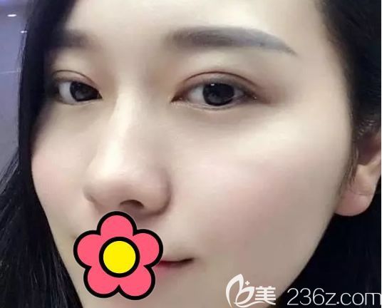 蘭州時光賈志蘭雙眼皮失敗修復效果案例