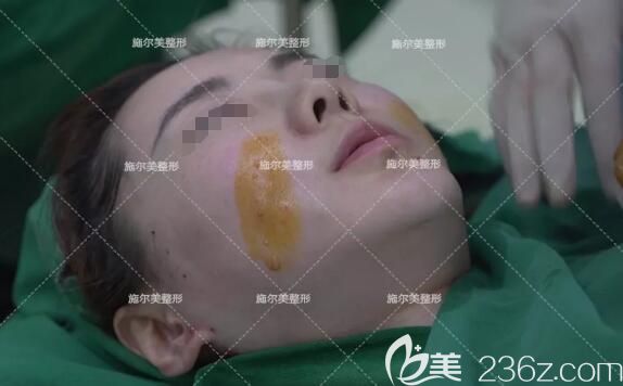 做線雕微整術(shù)前面部消毒