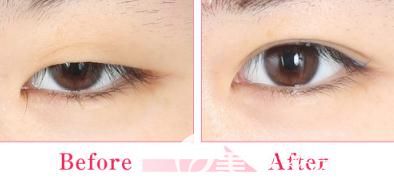 日本中央整形做埋線雙眼皮單眼細(xì)節(jié)對比