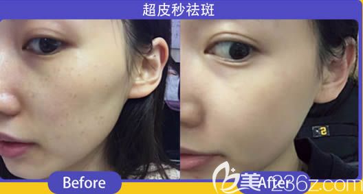 福州臺(tái)江陳麗萍激光祛斑三個(gè)月對(duì)比效果 福州臺(tái)江陳麗萍激光祛斑三個(gè)月對(duì)比效果