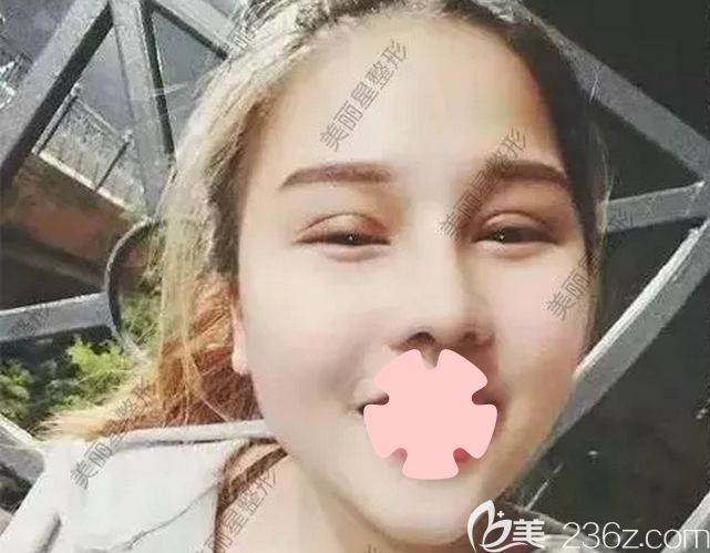我在南寧美麗星做雙眼皮和隆鼻第7天拆線照片