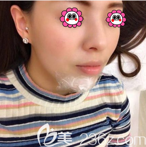 <!--<i data=20240703-sp></i>-->醫(yī)生給我做玻尿酸墊下巴當(dāng)天敷麻樣子