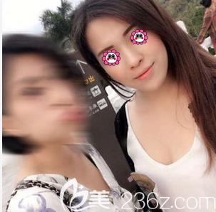 北京惠合嘉美醫(yī)院玻尿酸墊下巴案例