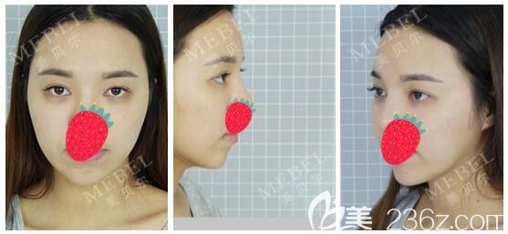 面診南京美貝爾術(shù)前眼睛和下巴有缺陷 面診南京美貝爾術(shù)前眼睛和下巴有缺陷