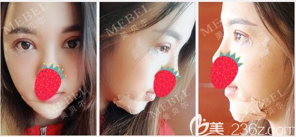 術(shù)后三天在南京美貝爾做下巴和眼綜合術(shù)后三天 術(shù)后三天在南京美貝爾做下巴和眼綜合術(shù)后三天