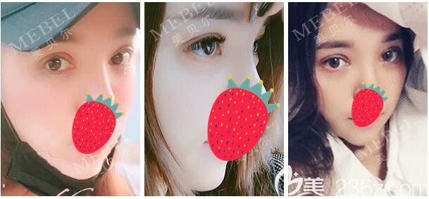 南京美貝爾做眼綜合和假體墊下巴術(shù)后半個(gè)月恢復(fù) 南京美貝爾做眼綜合和假體墊下巴術(shù)后半個(gè)月恢復(fù)