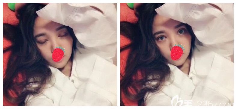 南京美貝爾眼綜合+假體豐下巴案例分享：丑了20年變美只用了一個(gè)月