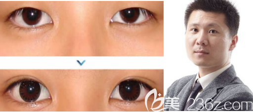 歷下寶琳娜雙眼皮案例