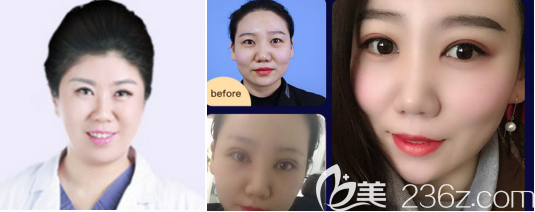 濟(jì)南海峽雙眼皮案例