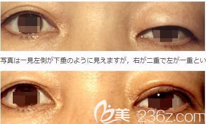 西山美容形成外科醫(yī)院眼瞼下垂修正