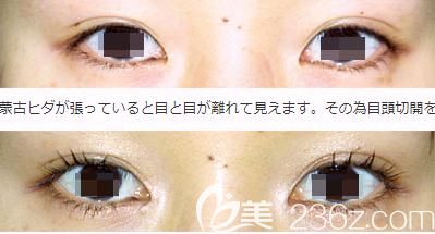 西山美容形成外科醫(yī)院開(kāi)眼角手術(shù)