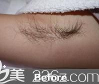 ALETHEIA美容皮膚科脫毛前 ALETHEIA美容皮膚科脫毛前