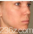 到日本朝日美容外科做的去皺前 到日本朝日美容外科做的去皺前