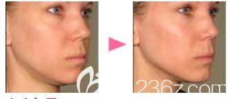 到日本朝日美容外科做的去皺前后對比 到日本朝日美容外科做的去皺前后對比