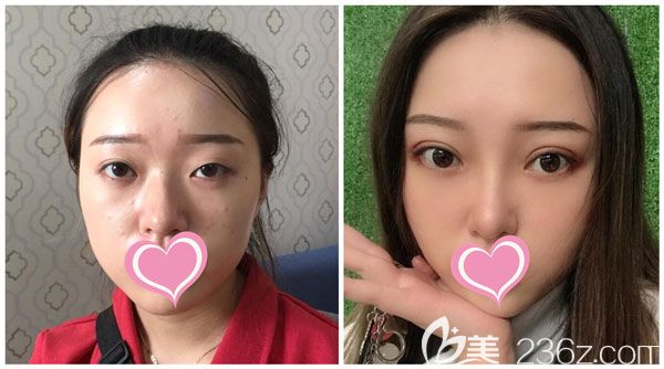 昆明韓辰肖玉亮做無痕媚眼雙眼皮效果對比圖