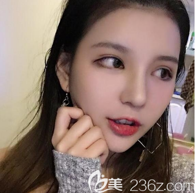 廣州藝美李闖隆鼻案例7天拆線 廣州藝美李闖隆鼻案例7天拆線