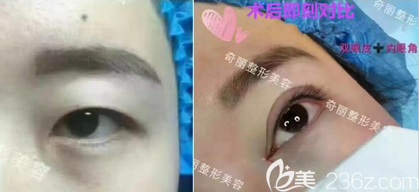 攀枝花奇麗雙眼皮開(kāi)眼角術(shù)后即刻對(duì)比照片 攀枝花奇麗雙眼皮開(kāi)眼角術(shù)后即刻對(duì)比照片